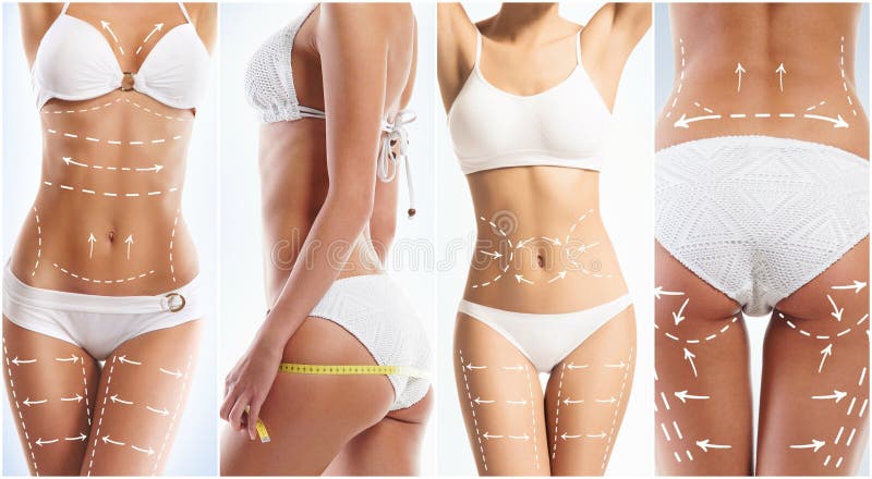 Collage of a female body with arrows. Burn, liposuction.
