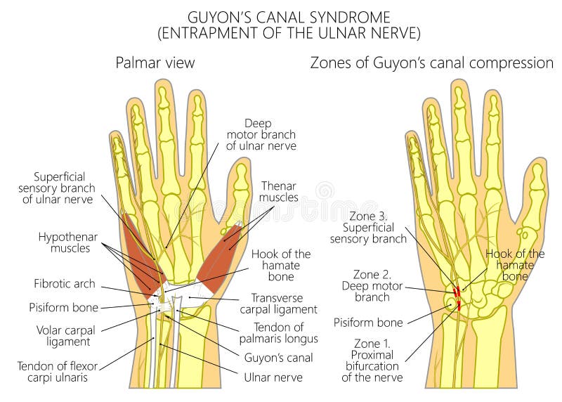 Colocación de trampas del nervio cubital en la muñeca en el cana de Guyonâ€™s
