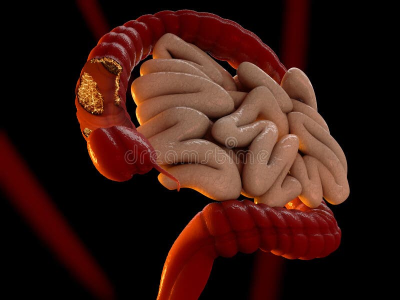 Colon cancer concept as a medical illustration of a large intestine