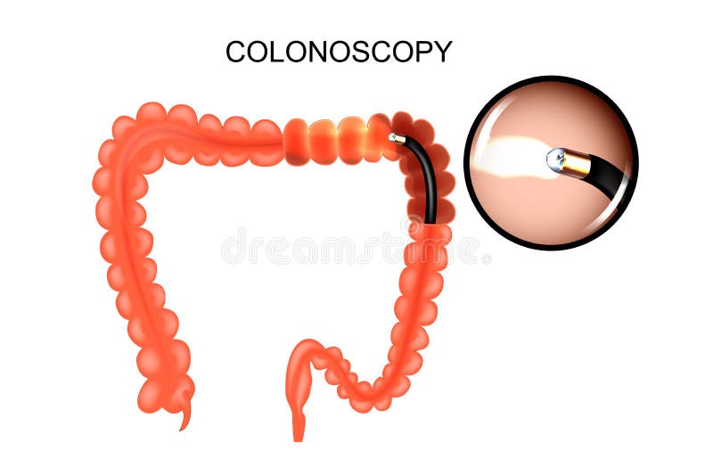 Vector illustration of large intestine, colonoscop. medicine. Vector illustration of large intestine, colonoscop. medicine