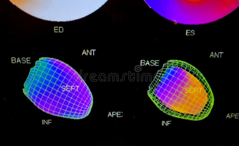 Color adenosine cardiac stress test images on black background. Colorful adenosine cardiac stress test images