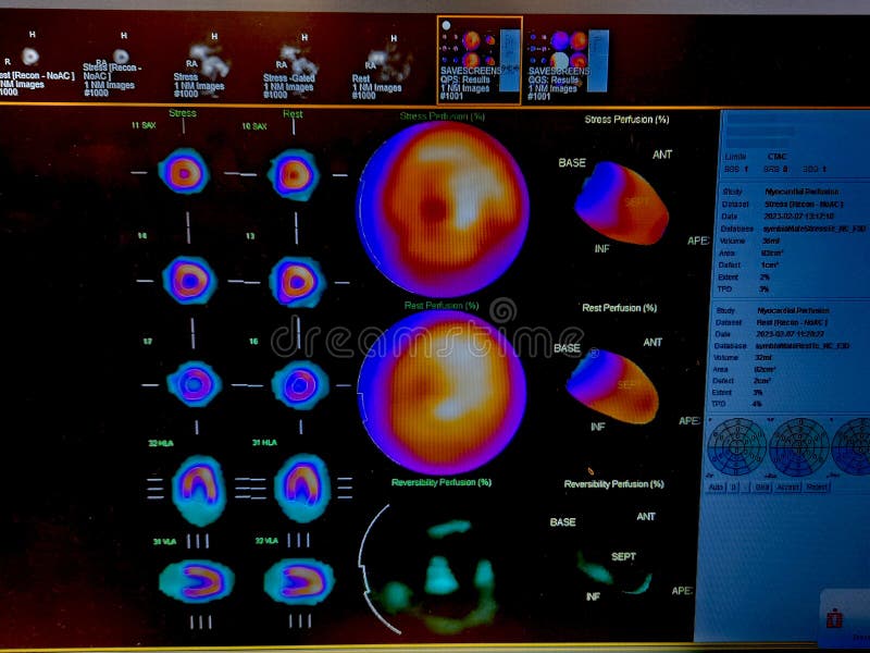 Color adenosine cardiac stress test images on black background
