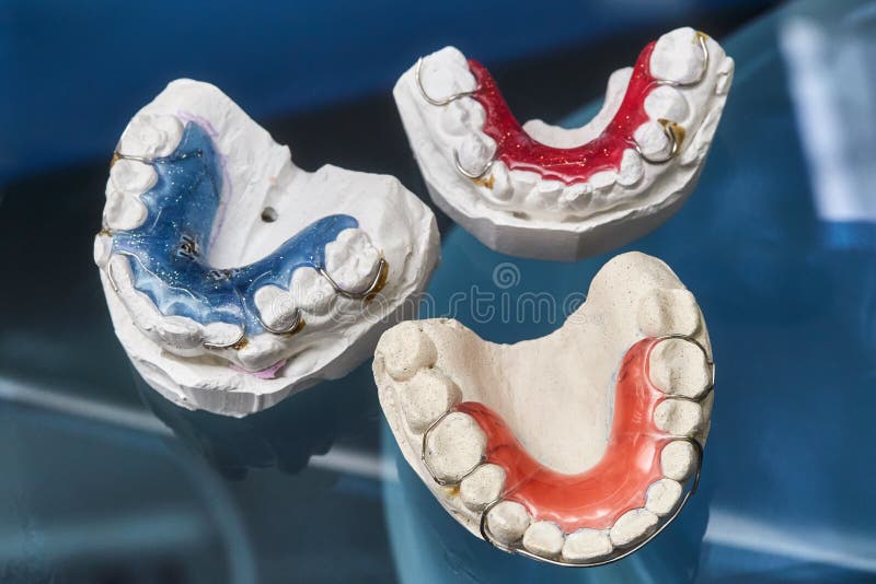 Colorful dental braces or retainer on teeth mold, clay human gums model  Stock Photo - Alamy