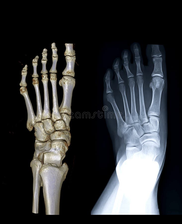 Comparación de la imagen de representación 3D del pie izquierdo de la vista AP e imagen de rayos X imagenes de archivo Comparación de la imagen de representación 3D del pie izquierdo de la vista AP e imagen de rayos X imagenes de archivo