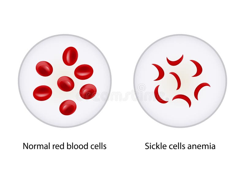 Comparaison entre les globules rouges normaux et l'anémie des cellules de la faucille illustration libre de droits Comparaison entre les globules rouges normaux et l'anémie des cellules de la faucille illustration libre de droits