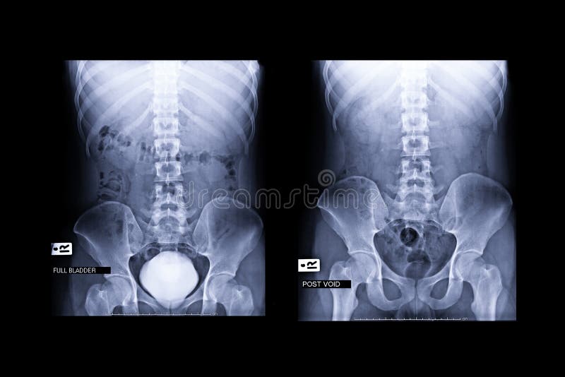 Compare Intravenous pyelogram or I V P is an X-ray exam of urinary tract after injection contrast media 库存图片