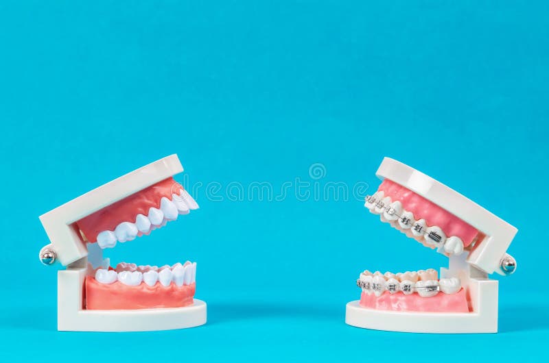 Comparez Le Modèle De Dent Et Le Modèle De Dent à La Bague Dentaire De Fil  En Métal Image stock - Image du effectué, dispositif: 131300807