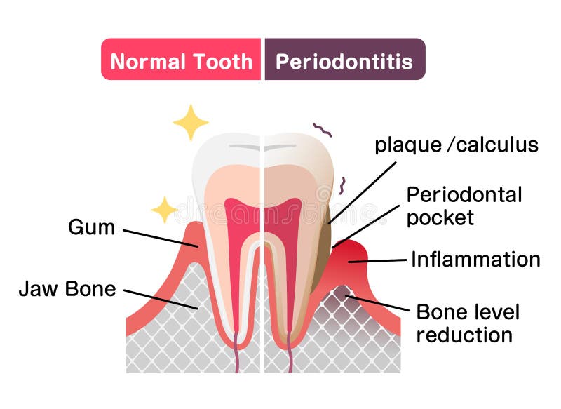 Comparison of normal teeth and periodontal disease. flat vector illustration. Normal cross vectors