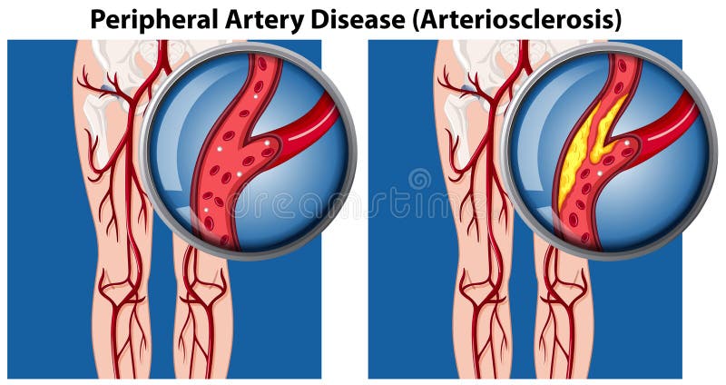 A Comparison of Peripheral Artery Disease stock illustration A Comparison of Peripheral Artery Disease stock illustration