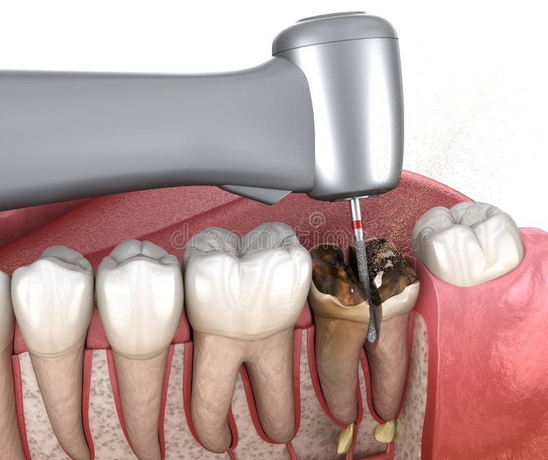 Complex Tooth Extraction. Medically Accurate 3D Illustration of Dental
