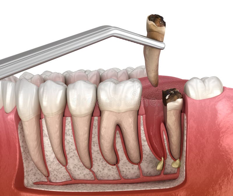 Complex Tooth Extraction. Medically Accurate 3D Illustration of Dental