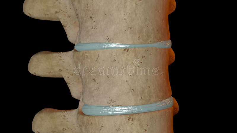 Compression fracture of the vertebra