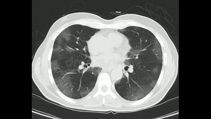 Computed Tomography of the chest high resolution CT chest in a confirmed case of COVID-19 Corona virus stock video footage.