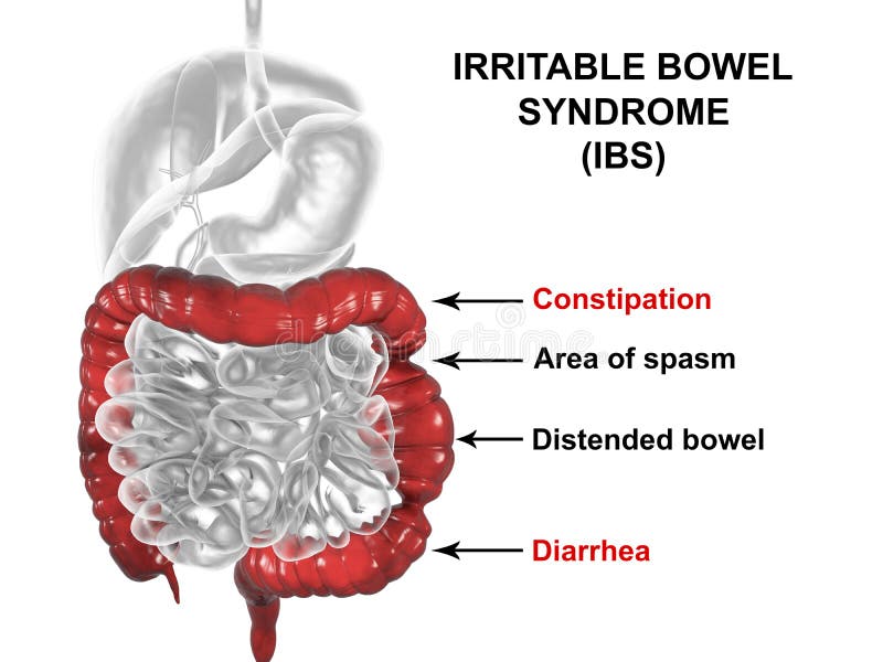 Concept Médical Du Syndrome Du Côlon Irritable IBS Illustration Stock