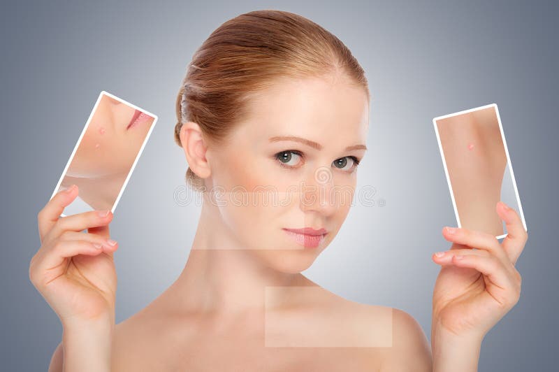 Concept skincare. Huid van schoonheids jonge vrouw met acne royalty-vrije stock fotografie Concept skincare. Huid van schoonheids jonge vrouw met acne royalty-vrije stock fotografie