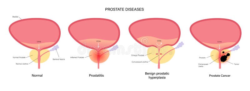 tipos de celulas de la prostata