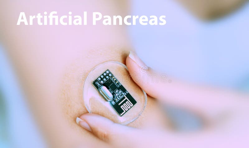 Artificial pancreas: Implantable device that automatically monitors blood glucose levels and delivers insulin to regulate diabetes. Artificial pancreas: Implantable device that automatically monitors blood glucose levels and delivers insulin to regulate diabetes