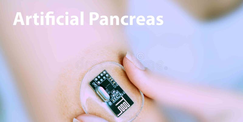 Artificial pancreas: Implantable device that automatically monitors blood glucose levels and delivers insulin to regulate diabetes. Artificial pancreas: Implantable device that automatically monitors blood glucose levels and delivers insulin to regulate diabetes