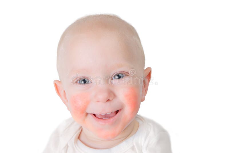 Food allergy concept - baby with dermatitis on cheeks, isolated on white. Food allergy concept - baby with dermatitis on cheeks, isolated on white
