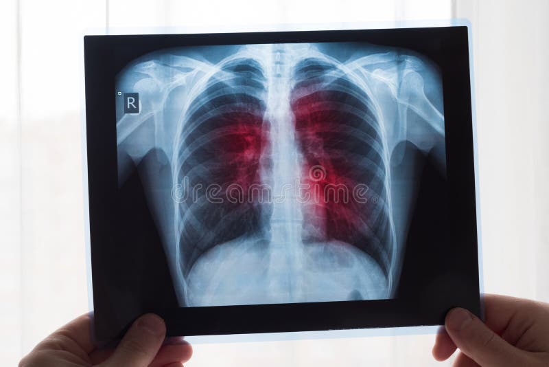 Lung radiography concept. Radiology doctor examining at chest x ray film of patient Lung Cancer or Pneumonia. Virus and bacteria infected the Human lungs. Patient with Lung Cancer or Pneumonia. Lung radiography concept. Radiology doctor examining at chest x ray film of patient Lung Cancer or Pneumonia. Virus and bacteria infected the Human lungs. Patient with Lung Cancer or Pneumonia