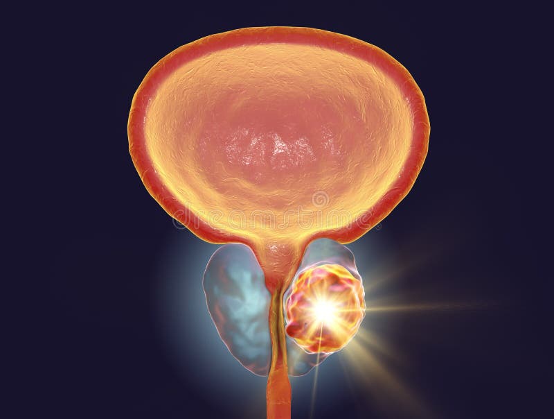 Conceptueel beeld voor prostate kankerbehandeling vector illustratie Conceptueel beeld voor prostate kankerbehandeling vector illustratie