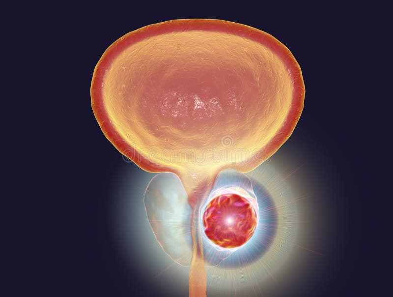 Conceptueel beeld voor prostate kankerbehandeling royalty-vrije illustratie Conceptueel beeld voor prostate kankerbehandeling royalty-vrije illustratie