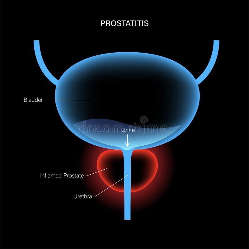 prostatitis kvantum