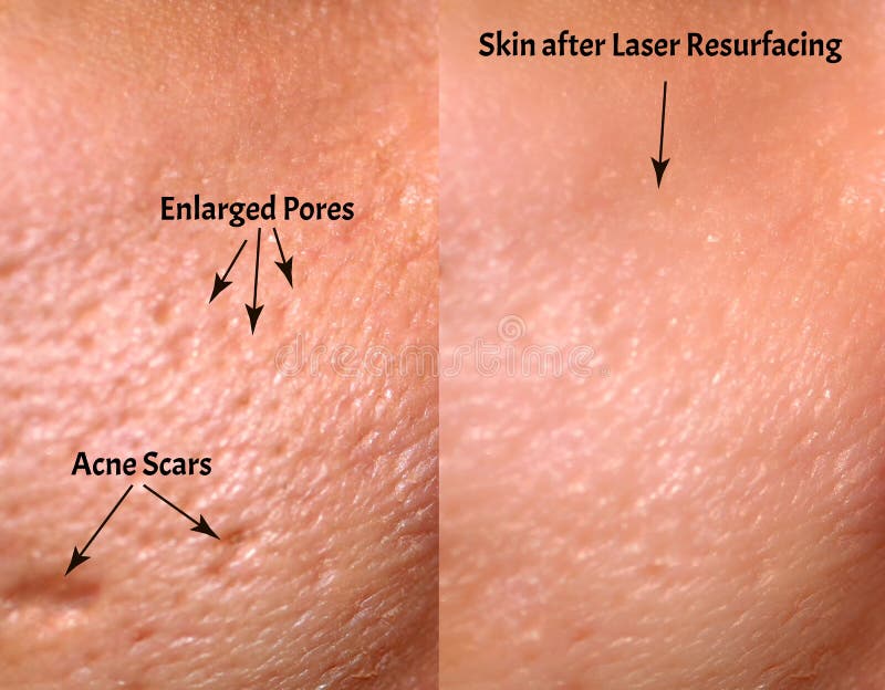 Confronto della pelle prima e dopo la risurrezione del laser Pelle con acne, cicatrici dell'acne, pori ingranditi