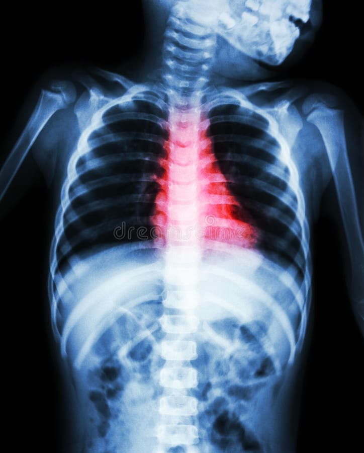 Congenital Heart Disease , Rheumatic Heart Disease ( X-ray body of child and red color on heart area )