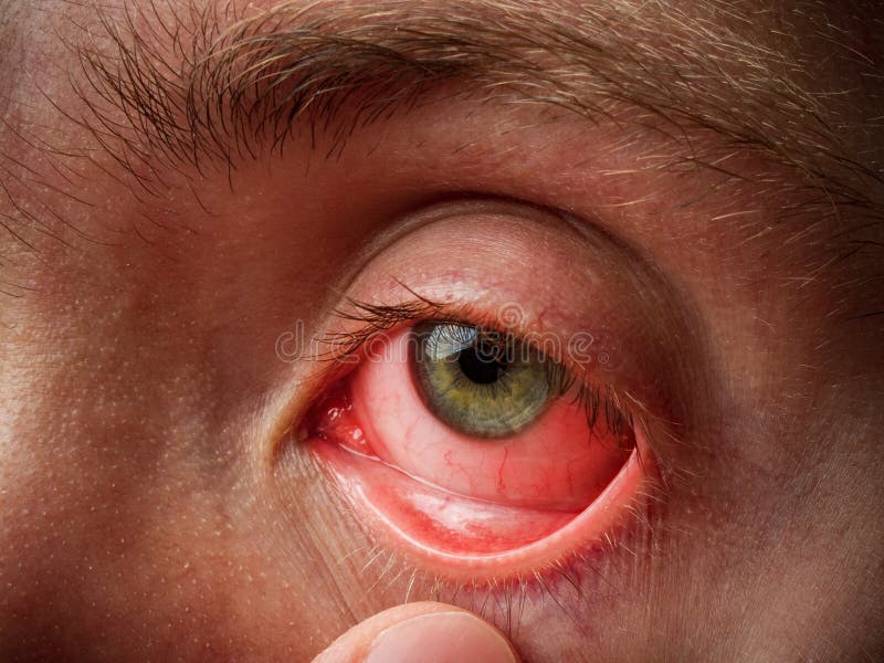 Olhos Irritados De Uma Menina Que Ficasse Doente Com Conjuntivite Foto de Stock - Imagem de adolescente, inchado: 146506816
