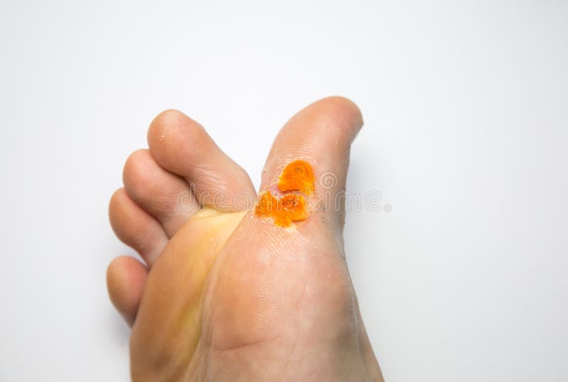 salicylic acid plantar warts