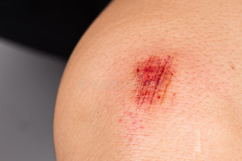 Contusion ensanglantée fraîche enroulée sur le genou photos stock Contusion ensanglantée fraîche enroulée sur le genou photos stock