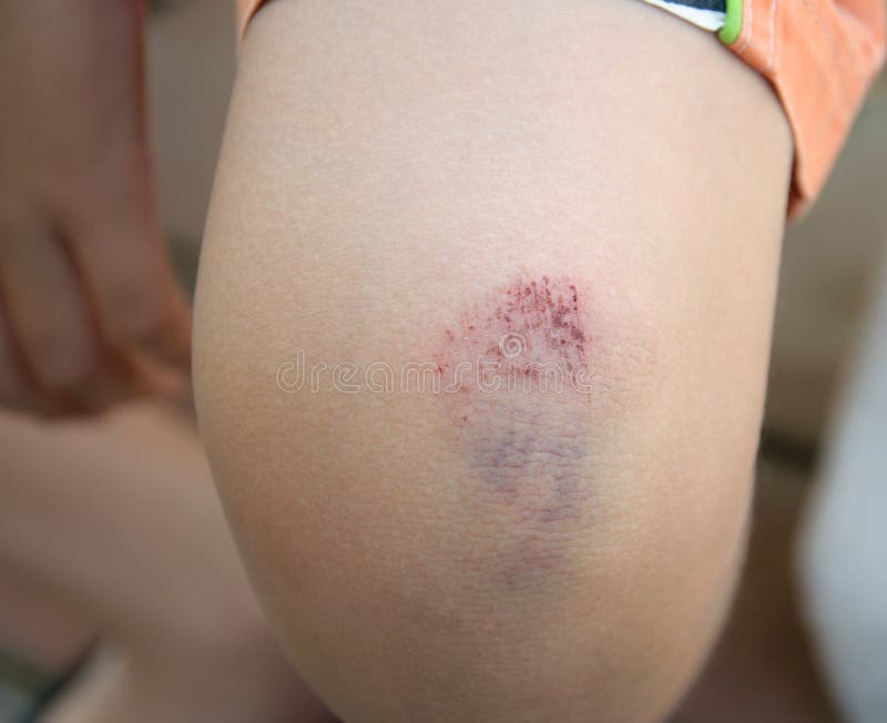 Contusion sur le genou images stock Contusion sur le genou images stock