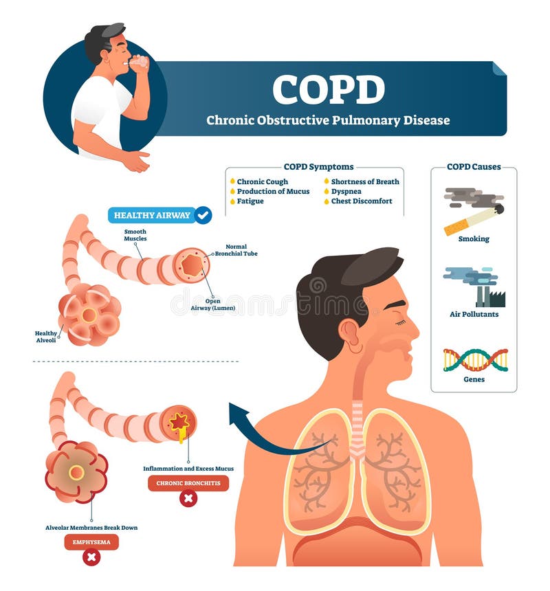 COPD-Vektorillustration Beschriftete chronische hemmende Lungenerklärung vektor abbildung COPD-Vektorillustration Beschriftete chronische hemmende Lungenerklärung vektor abbildung