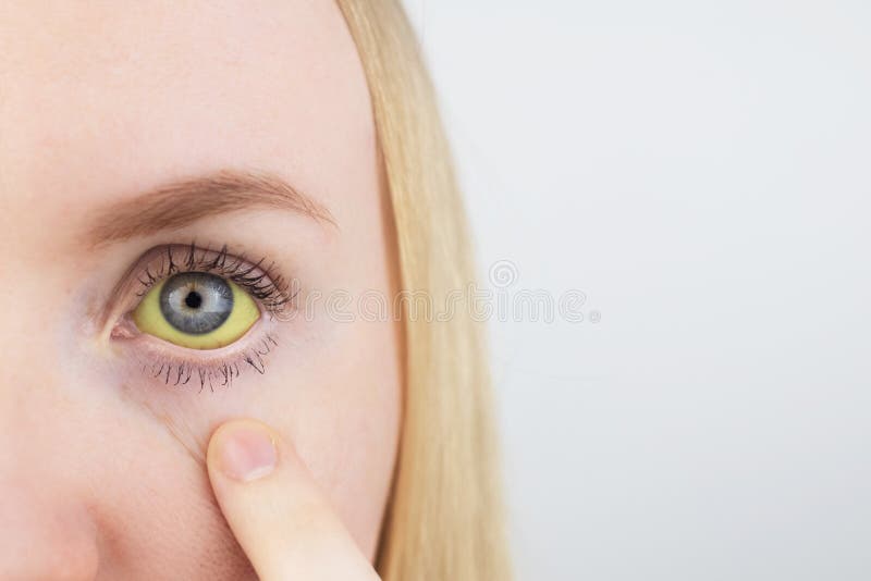 Cor Amarela Do Olho Masculino. Sintomas De Icterícia Hepatite Ou Problemas No Fígado Da Vesícula Biliar Do Trato Gastrointestinal Imagem de Stock - Imagem de descolorado, problemas: 190308633