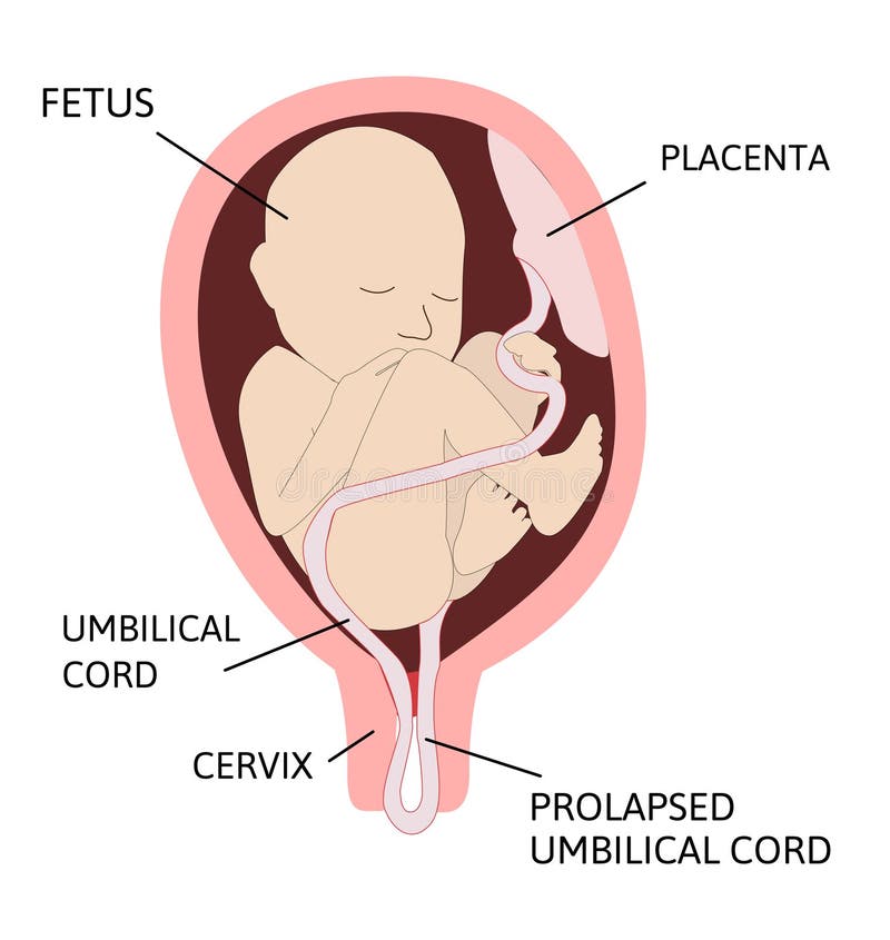 Cordon Ombilical Autour Du Cou Corde Nuchal Deux Loopes Est Sur Le Cou De L Enfant Illustration Stock Illustration Du Danger Pathologie Cordon Ombilical Autour Du Cou Corde Nuchal Deux Loopes Est Sur Le Cou De L Enfant Illustration Stock Illustration Du Danger Pathologie