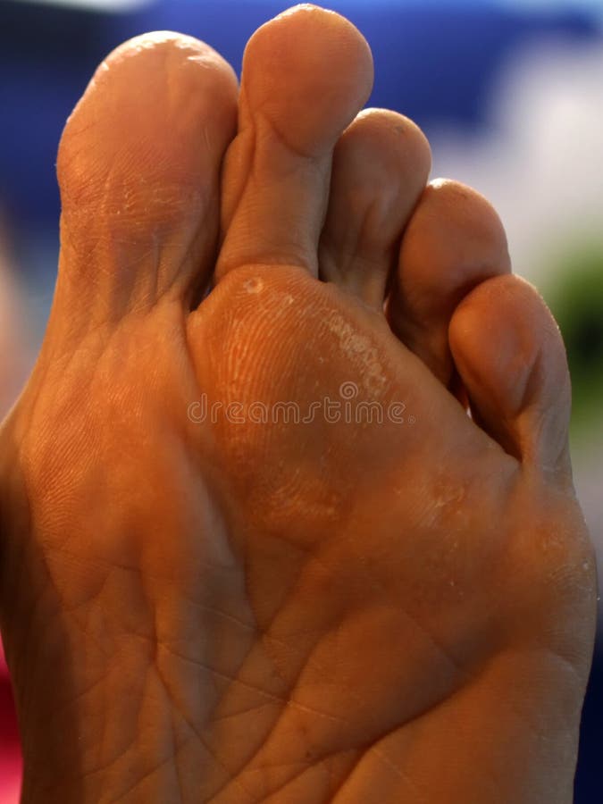 Corn on the Foot. Foot Sole with Corn. Stock Image Image of natural