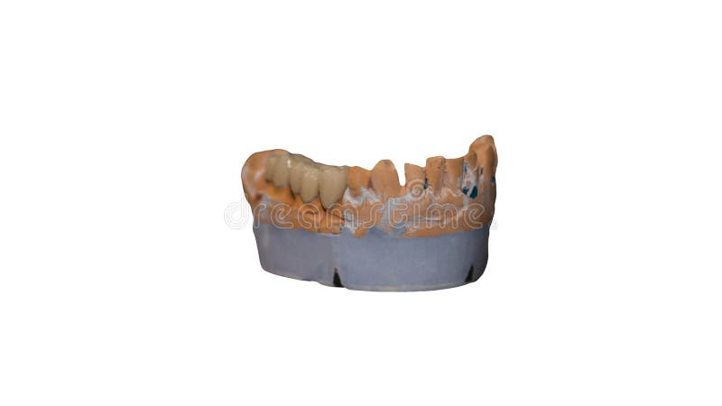 Corona De Cerámica De Un Diente Sobre Un Modelo De Yeso Dental El Trabajo  De Un Técnico Dental Aislado En Un Fondo Blanco Imagen de archivo - Imagen  de instrumento, laboratorio: 206504893