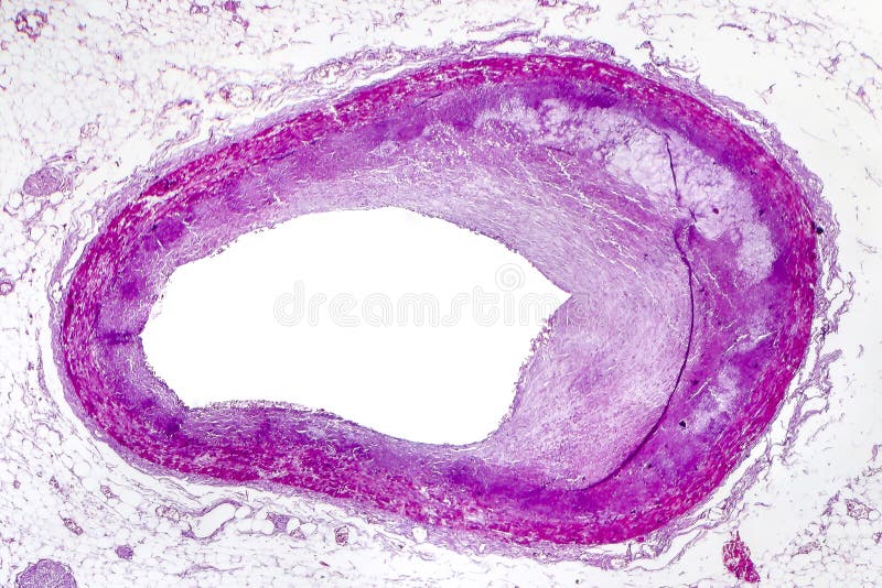 Coronaire atherosclerose, lichte micrograaf stock afbeeldingen Coronaire atherosclerose, lichte micrograaf stock afbeeldingen