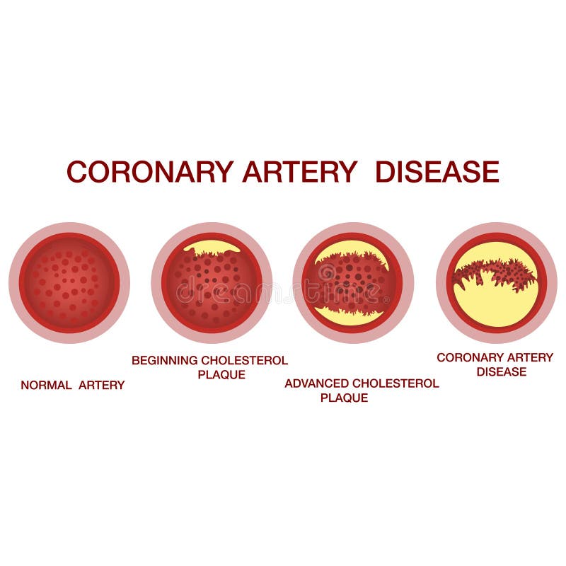 Coronary artery disease concept. Healthy and narrowed arteries with plaques