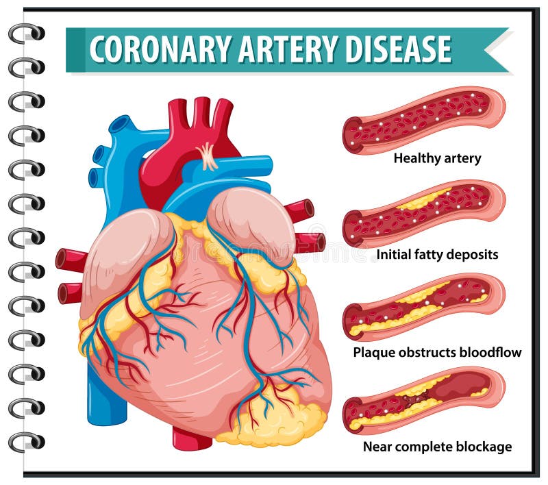 Coronary Artery Disease for health education Infographic vector illustration
