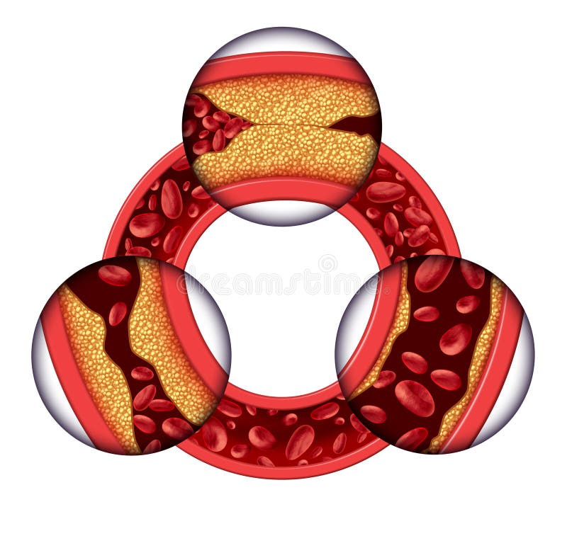 Ischemická choroba srdca lekárske koncept, ako kruhové žily s postupným doska tvorbe výsledného v upchaté tepny a ateroskleróza s trojrozmernou ľudskej anatómie schéma riziká cholesterolu elektrinou.