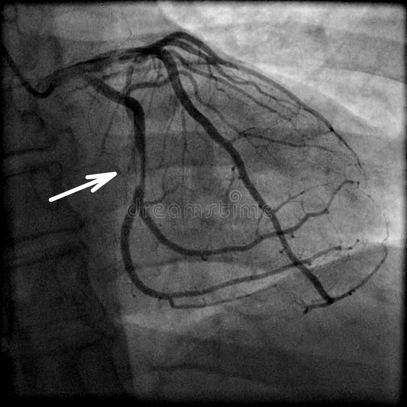 Stenosi della sinistra coronaria circonflessa (freccia) in un paziente con malattia coronarica.