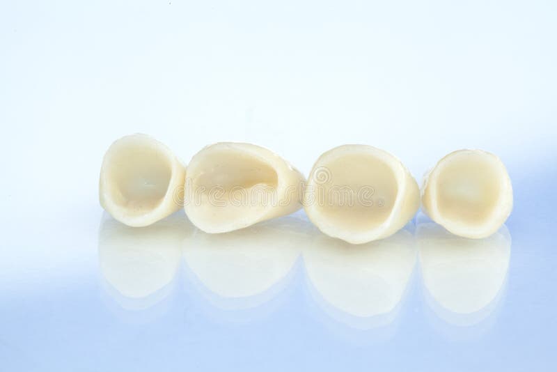Corone dentarie ceramiche libere del metallo immagini stock libere da diritti Corone dentarie ceramiche libere del metallo immagini stock libere da diritti
