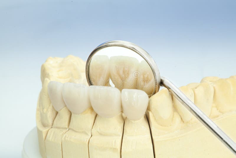 Corone dentarie ceramiche libere del metallo fotografia stock libera da diritti Corone dentarie ceramiche libere del metallo fotografia stock libera da diritti