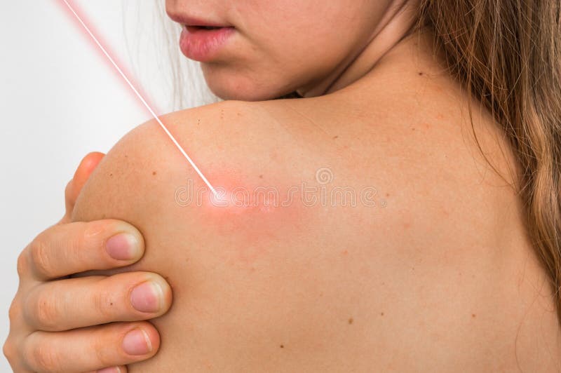 Corpo da mulher e cirurgia do laser imagem de stock royalty free Corpo da mulher e cirurgia do laser imagem de stock royalty free