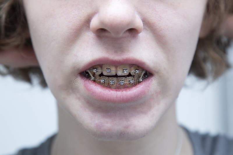 Correction of Bite with Braces. a Young Man with Braces Stock Image