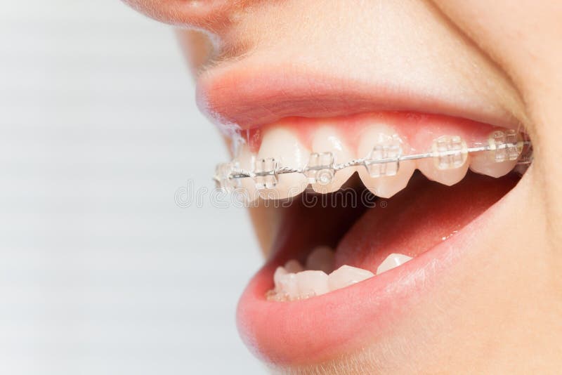 Correction d'orthodonties des mâchoires avec la parenthèse claire image libre de droits Correction d'orthodonties des mâchoires avec la parenthèse claire image libre de droits
