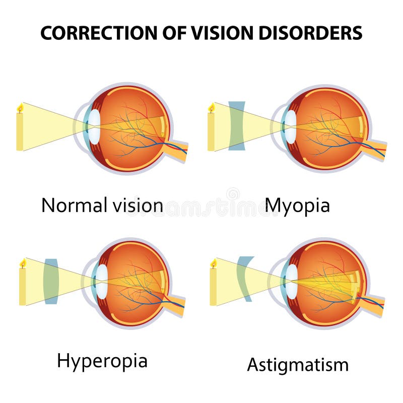 veleszületett myopia vagy hyperopia
