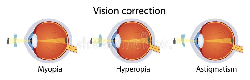 Correzione di vari disturbi visivi attraverso l'obiettivo. iperopia miopia astigmatismo. illustrazione vettoriale